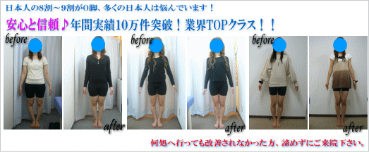 O脚矯正は美脚センターで安心 O脚はお任せ